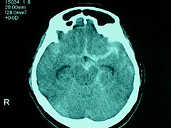 図6 クモ膜下出血のCT画像