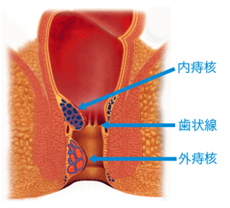 痔核（いぼ痔）