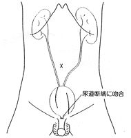 自然排尿型代用膀胱