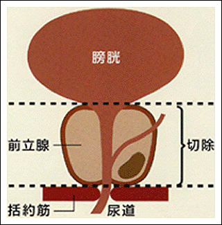 前立腺全摘除術1