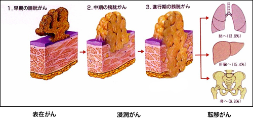 進行の程度