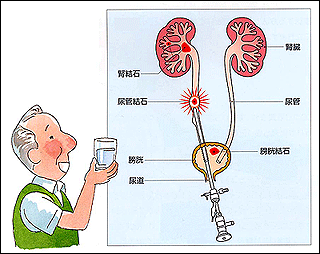 尿管内視鏡による砕石術