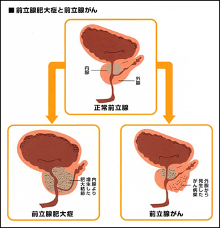 前立腺肥大症と前立腺がん