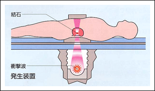 体外衝撃波結石破砕術