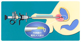 肥大症の手術