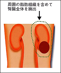 腎摘除術