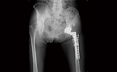 人工関節特殊例・再置換術に関して2