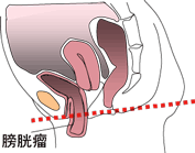 膀胱瘤