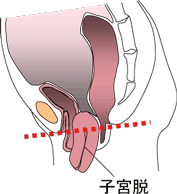 子宮脱