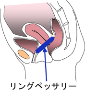 リングペッサリー