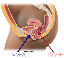 TVMメッシュ手術