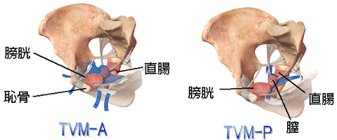 TVM-A,TVM-P