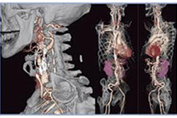 頚部血管３D / 体幹部血管３D