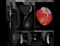 心臓血管３D