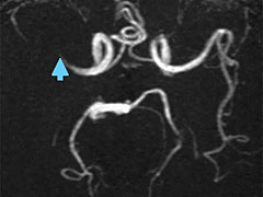 図3 rt-PA投与前MRA　右中大脳動脈水平部で完全閉塞