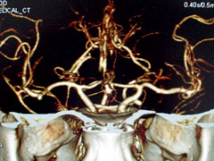 図7 3次元立体CT脳血管撮影