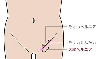 大腿（だいたい）ヘルニア