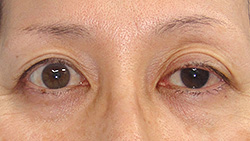 例1：眼瞼挙筋前転術1