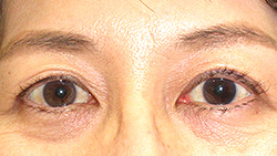 例1：眼瞼挙筋前転術2