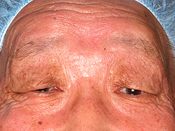 例2：眼瞼挙筋前転術1