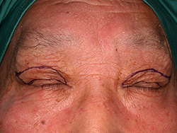 例2：眼瞼挙筋前転術2