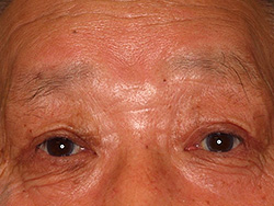 例2：眼瞼挙筋前転術3