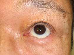 例：眼瞼内反1
