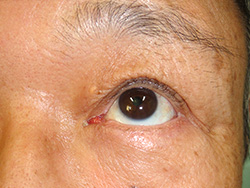 例：眼瞼内反2