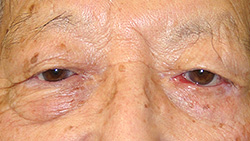 例：下眼瞼外反2