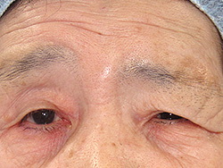 例：眉毛下垂1