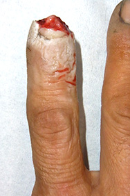 例1：手の外傷1