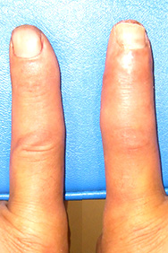 例1：手の外傷2