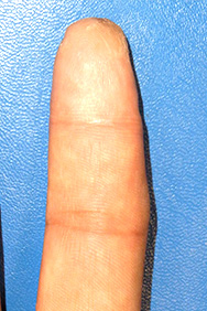 例1：手の外傷3