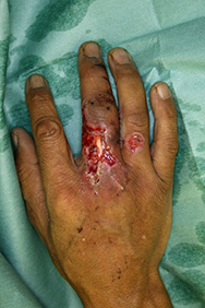例2：手の外傷1