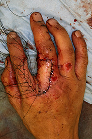 例2：手の外傷2