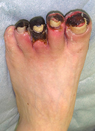 例2：足の皮膚潰瘍1