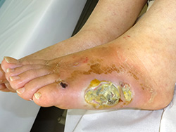 例1：足の皮膚潰瘍1