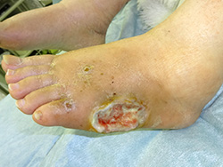 例1：足の皮膚潰瘍2