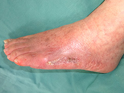 例1：足の皮膚潰瘍3