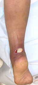 例：外傷による皮膚潰瘍1