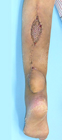 例：外傷による皮膚潰瘍3