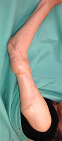 例：化膿性関節炎による皮膚潰瘍