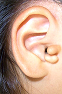 例：副耳1