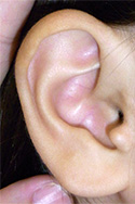 例：副耳2