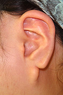 例：耳垂裂1