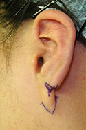 例：耳垂裂2