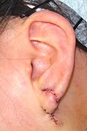 例：耳垂裂3