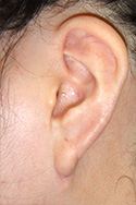例：耳垂裂4