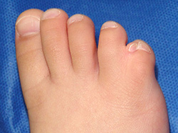 例：多合趾症1