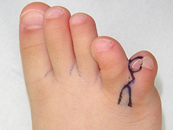 例：多合趾症2